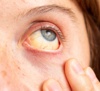 Es kommt vor, dass die Lederhaut (weisse Augenhaut) sich gelblich verfärbt. Was hat es mit den sogenannten „gelben Augen“ auf sich? Erfahren Sie jetzt mehr!